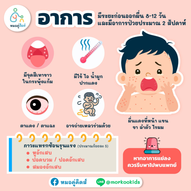 โรคหัดในเด็ก_4