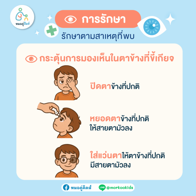 การรักษาโรคตาขี้เกียจในเด็ก