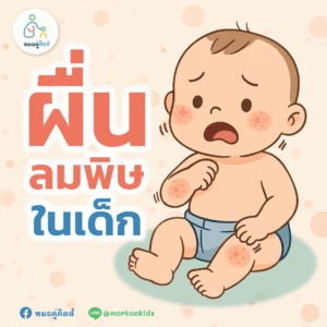 รู้จัก! ผื่นลมพิษในเด็ก ควรดูแลและป้องกันลูกน้อยอย่างไร?