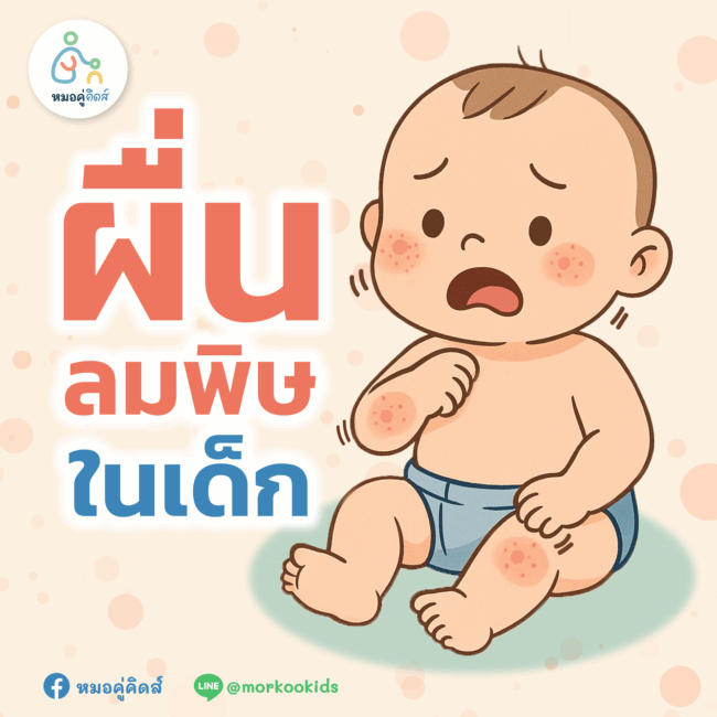 ผื่นลมพิษในเด็ก