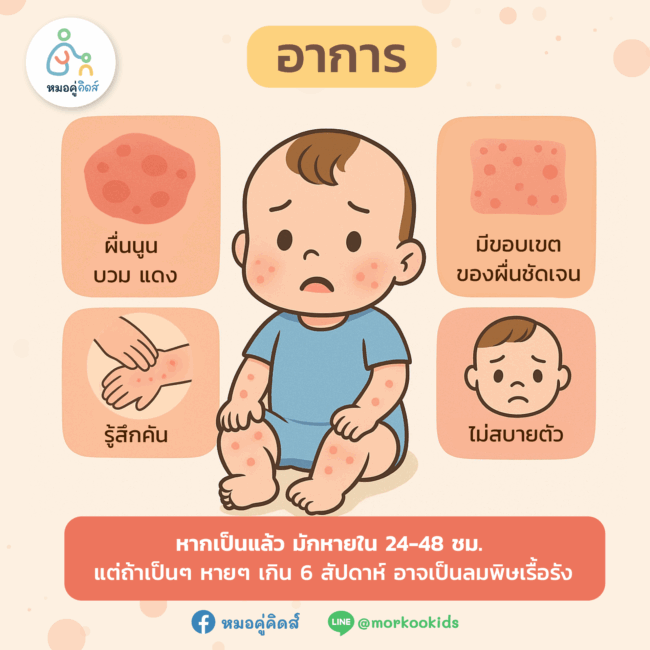 อาการผื่นลมพิษในเด็ก